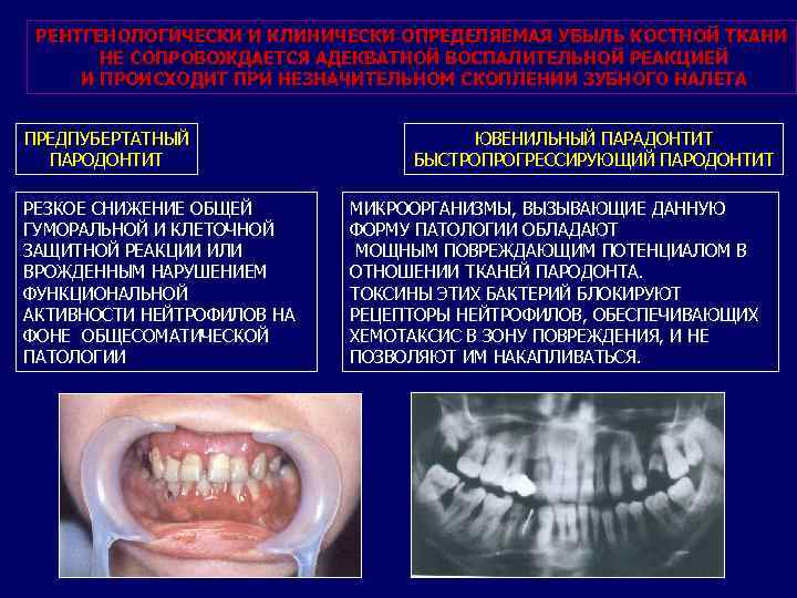 РЕНТГЕНОЛОГИЧЕСКИ И КЛИНИЧЕСКИ ОПРЕДЕЛЯЕМАЯ УБЫЛЬ КОСТНОЙ ТКАНИ НЕ СОПРОВОЖДАЕТСЯ АДЕКВАТНОЙ ВОСПАЛИТЕЛЬНОЙ РЕАКЦИЕЙ И ПРОИСХОДИТ