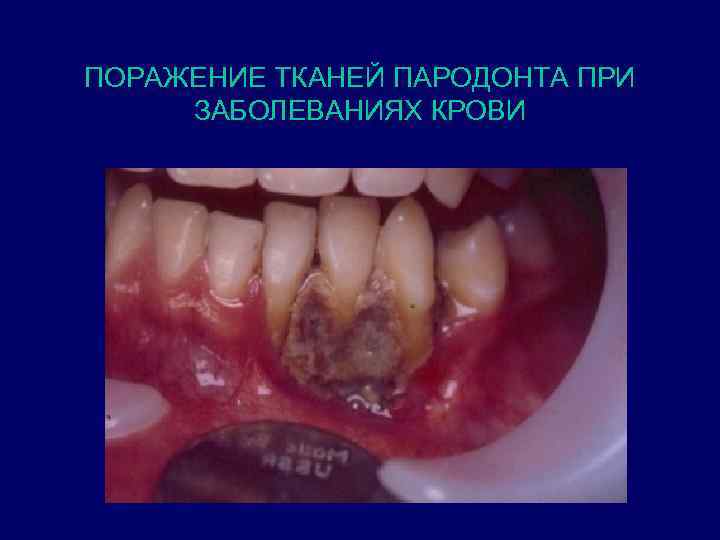 ПОРАЖЕНИЕ ТКАНЕЙ ПАРОДОНТА ПРИ ЗАБОЛЕВАНИЯХ КРОВИ 