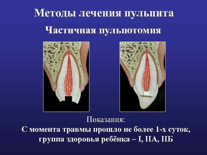 Методы лечения пульпита Частичная пульпотомия Показания: С момента травмы прошло не более 1 -х