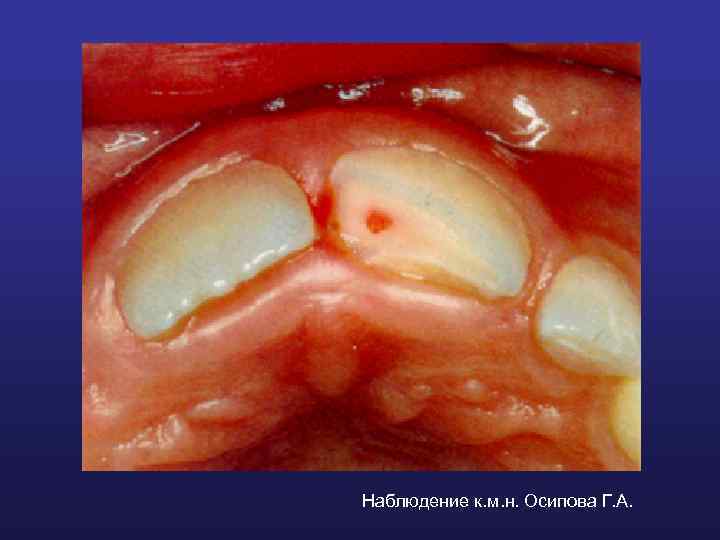 Наблюдение к. м. н. Осипова Г. А. 