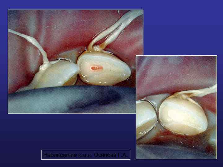 Наблюдение к. м. н. Осипова Г. А. 