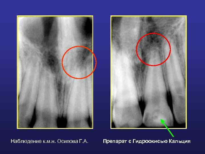Наблюдение к. м. н. Осипова Г. А. Препарат с Гидроокисью Кальция 