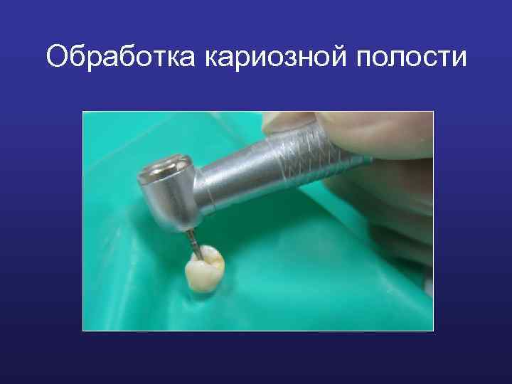 Обработка кариозной полости 