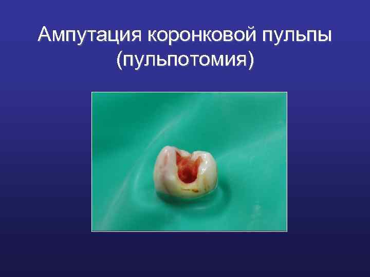 Ампутация коронковой пульпы (пульпотомия) 