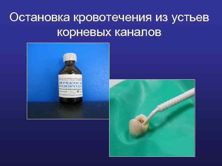 Остановка кровотечения из устьев корневых каналов 