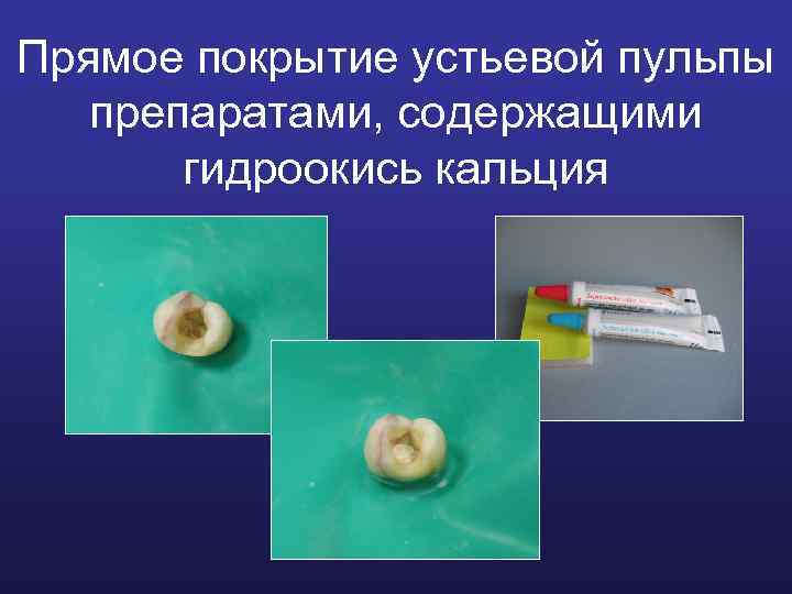 Прямое покрытие устьевой пульпы препаратами, содержащими гидроокись кальция 
