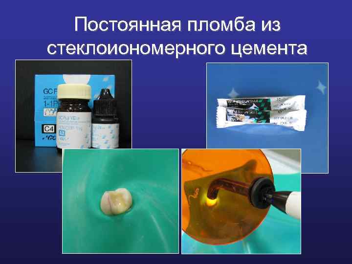 Постоянная пломба из стеклоиономерного цемента 