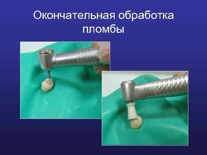 Окончательная обработка пломбы 