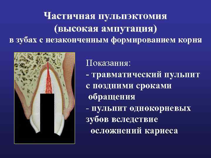 Частичная пульпэктомия (высокая ампутация) в зубах с незаконченным формированием корня Показания: - травматический пульпит