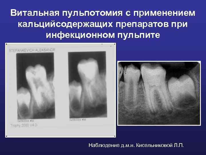 Витальная пульпотомия с применением кальцийсодержащих препаратов при инфекционном пульпите Наблюдение д. м. н. Кисельниковой