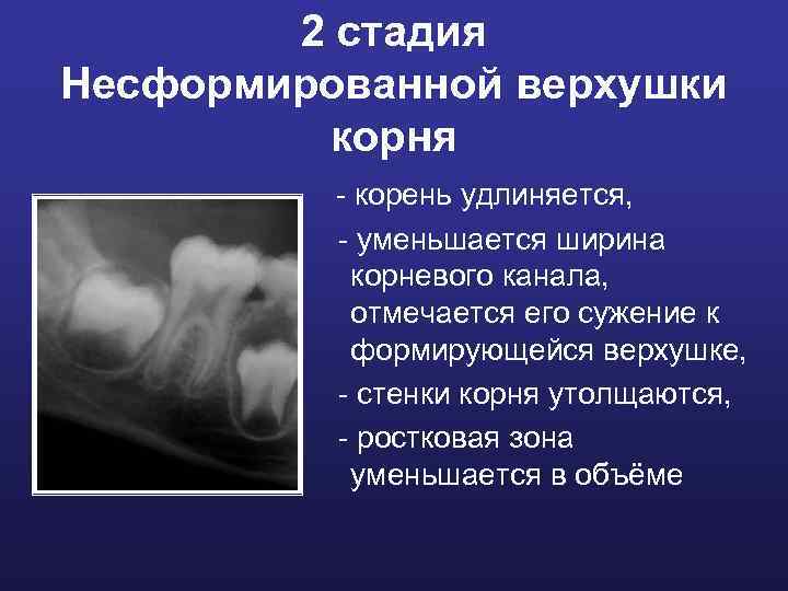 2 стадия Несформированной верхушки корня - корень удлиняется, - уменьшается ширина корневого канала, отмечается