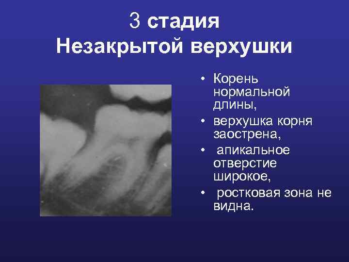 3 стадия Незакрытой верхушки • Корень нормальной длины, • верхушка корня заострена, • апикальное