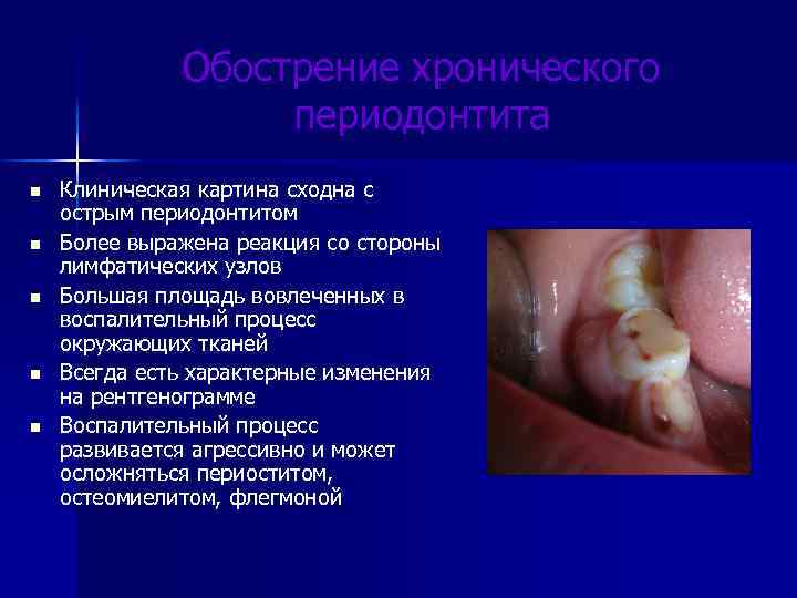 Обострение хронического периодонтита n n n Клиническая картина сходна с острым периодонтитом Более выражена