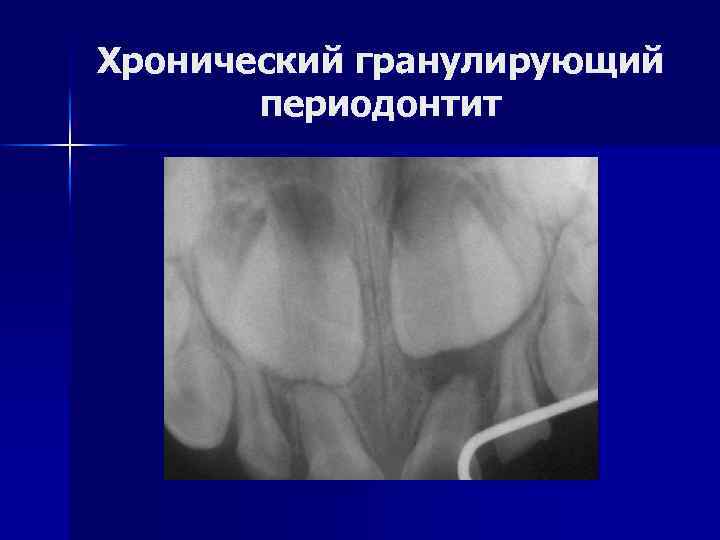 Хронический гранулирующий периодонтит 