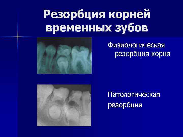 Резорбция корней временных зубов Физиологическая резорбция корня Патологическая резорбция 