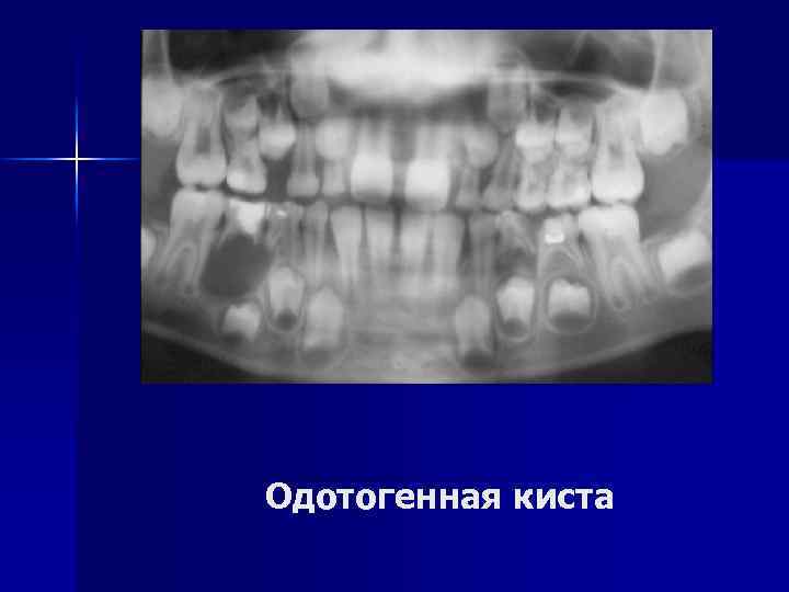 Одотогенная киста 