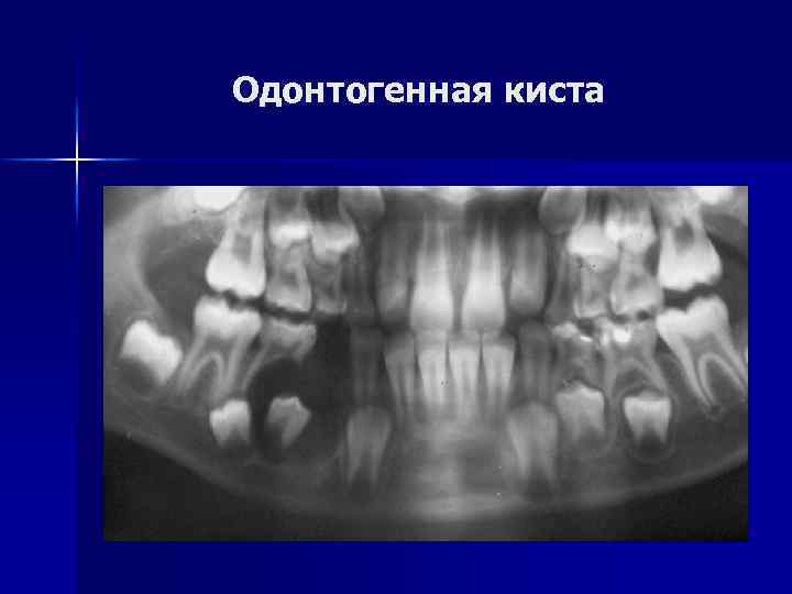 Одонтогенная киста 