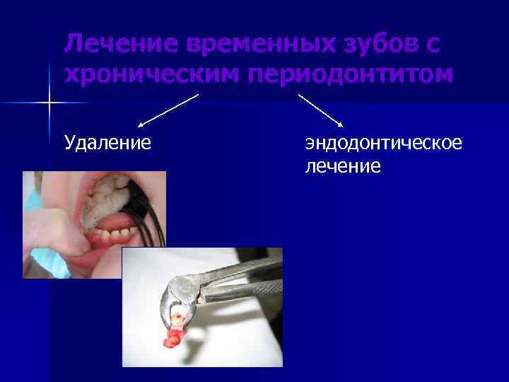Лечение временных зубов с хроническим периодонтитом Удаление эндодонтическое лечение 