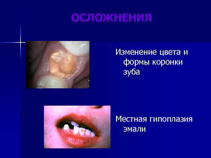 ОСЛОЖНЕНИЯ Изменение цвета и формы коронки зуба Местная гипоплазия эмали 