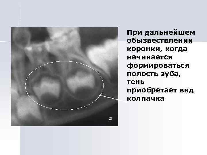 При дальнейшем обызвествлении коронки, когда начинается формироваться полость зуба, тень приобретает вид колпачка 2