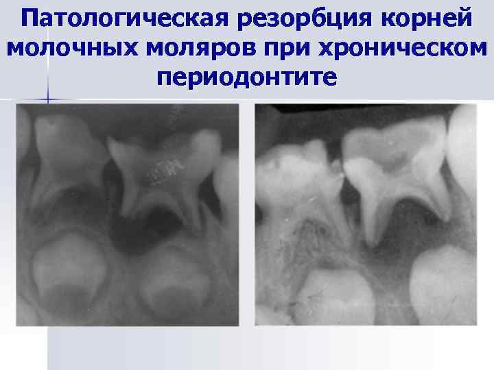 Патологическая резорбция корней молочных моляров при хроническом периодонтите 