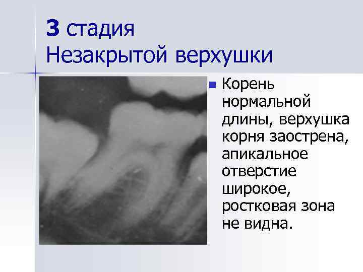 3 стадия Незакрытой верхушки n Корень нормальной длины, верхушка корня заострена, апикальное отверстие широкое,