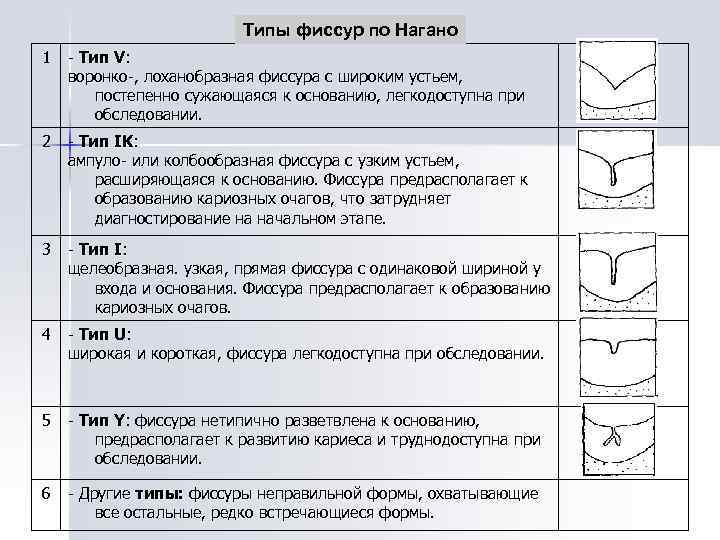 Типы фиссур по Нагано 1 - Тип V: воронко-, лоханобразная фиссура с широким устьем,