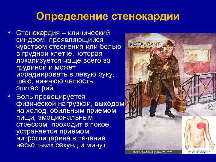 Определение стенокардии • Стенокардия – клинический синдром, проявляющийся чувством стеснения или болью в грудной