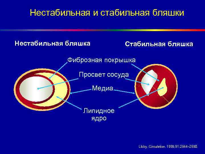 Нестабильная и стабильная бляшки Нестабильная бляшка Стабильная бляшка Фиброзная покрышка Просвет сосуда Meдиa Липидное