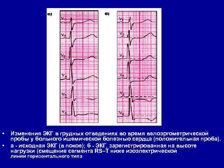  • • Изменения ЭКГ в грудных отведениях во время велоэргометрической пробы у больного