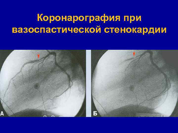 Коронарография при вазоспастической стенокардии 