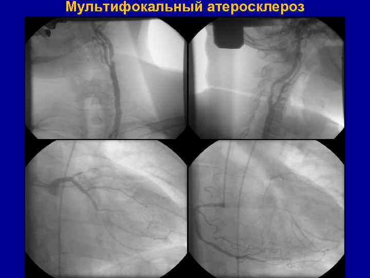 Мультифокальный атеросклероз 