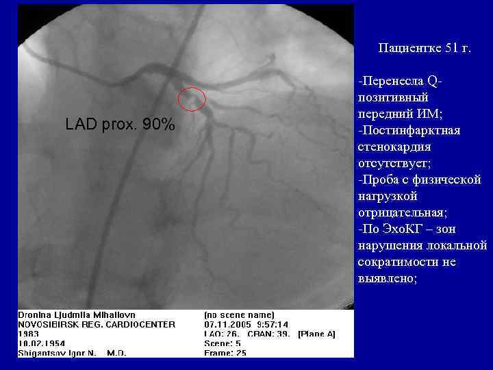 Пациентке 51 г. LAD prox. 90% -Перенесла Qпозитивный передний ИМ; -Постинфарктная стенокардия отсутствует; -Проба