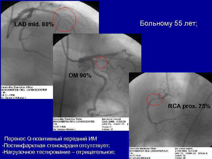 Больному 55 лет; LAD mid. 80% OM 90% RCA prox. 75% -Перенес Q-позитивный передний