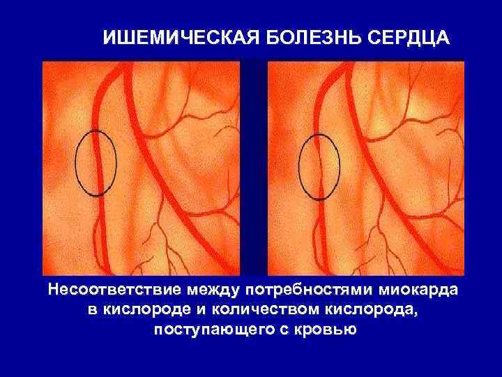 ИШЕМИЧЕСКАЯ БОЛЕЗНЬ СЕРДЦА Несоответствие между потребностями миокарда в кислороде и количеством кислорода, поступающего с