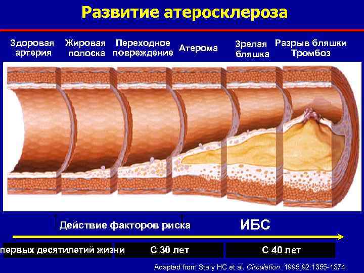 Развитие атеросклероза Здоровая артерия Жировая Переходное Атерома полоска повреждение Действие факторов риска первых десятилетий