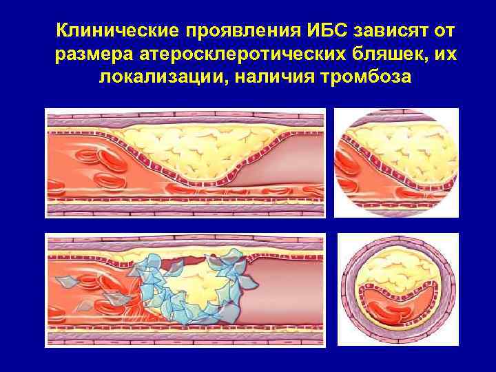 Клинические проявления ИБС зависят от размера атеросклеротических бляшек, их локализации, наличия тромбоза 