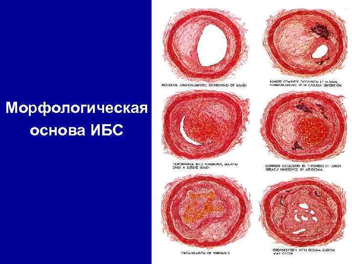 Морфологическая основа ИБС 