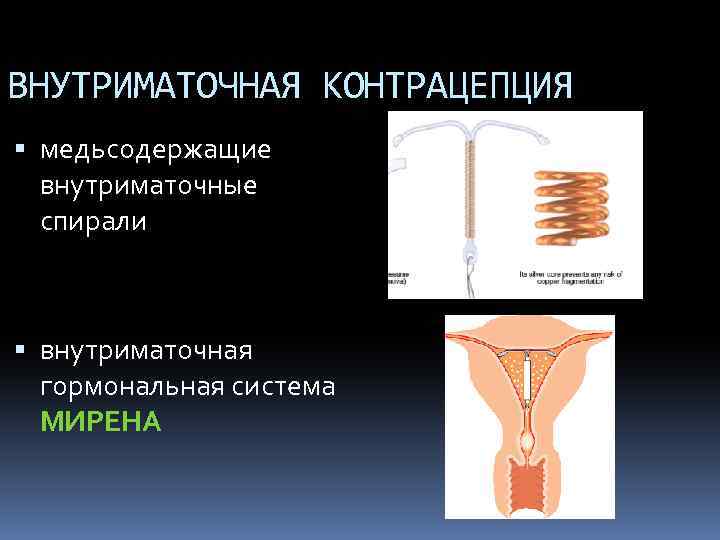 ВНУТРИМАТОЧНАЯ КОНТРАЦЕПЦИЯ медьсодержащие внутриматочные спирали внутриматочная гормональная система МИРЕНА 