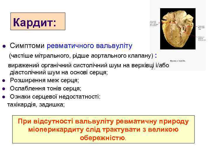 Кардит: l Симптоми ревматичного вальвуліту (частіше мітрального, рідше аортального клапану) : виражений органічний систолічний