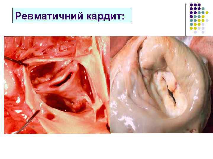 Ревматичний кардит: 