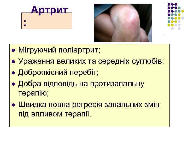  Артрит : l l l Мігруючий поліартрит; Ураження великих та середніх суглобів; Доброякісний