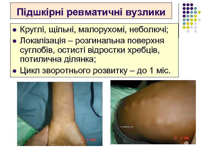 Підшкірні ревматичні вузлики l l l Круглі, щільні, малорухомі, неболючі; Локалізація – розгинальна поверхня