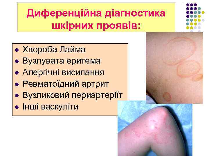 Диференційна діагностика шкірних проявів: l l l Хвороба Лайма Вузлувата еритема Алергічні висипання Ревматоїдний