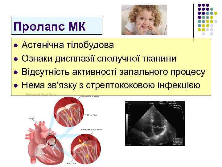 Пролапс МК l l Астенічна тілобудова Ознаки дисплазії сполучної тканини Відсутність активності запального процесу
