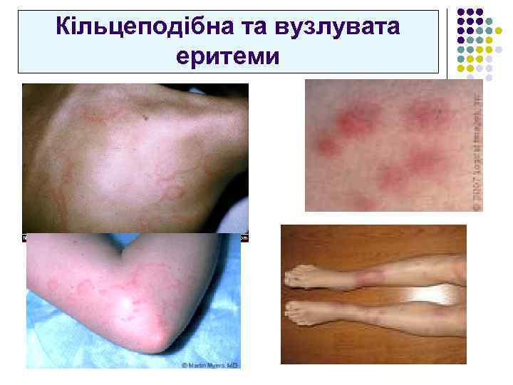 Кільцеподібна та вузлувата еритеми 
