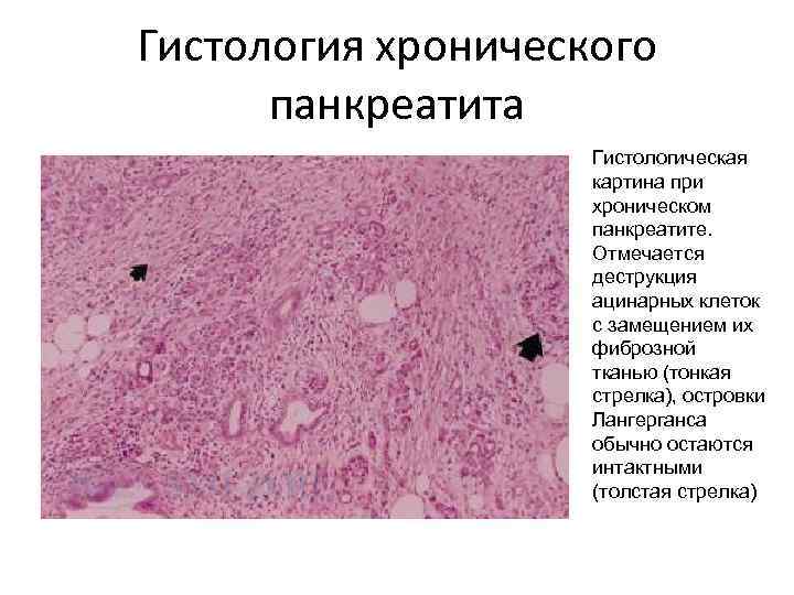 Гистология хронического панкреатита Гистологическая картина при хроническом панкреатите. Отмечается деструкция ацинарных клеток с замещением