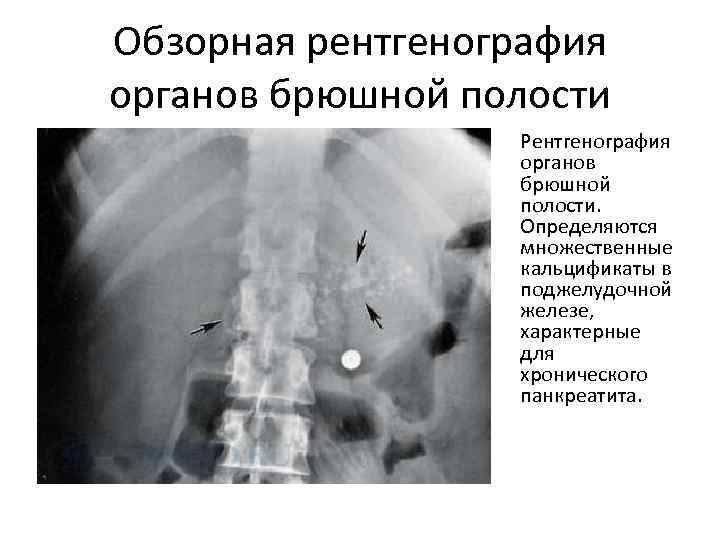 Обзорная рентгенография органов брюшной полости Рентгенография органов брюшной полости. Определяются множественные кальцификаты в поджелудочной