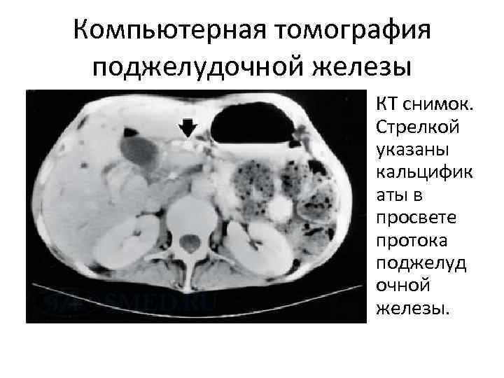 Компьютерная томография поджелудочной железы КТ снимок. Стрелкой указаны кальцифик аты в просвете протока поджелуд
