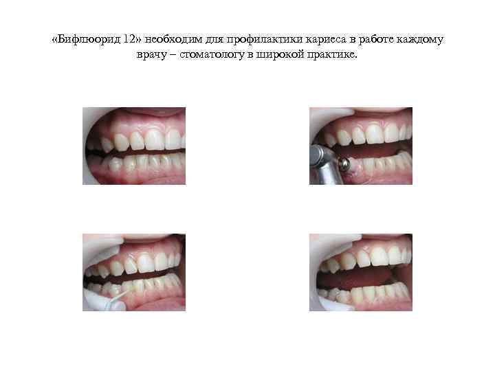  «Бифлюорид 12» необходим для профилактики кариеса в работе каждому врачу – стоматологу в